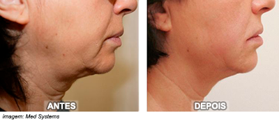 ultraformer (ultrassom microfocado) antes e depois