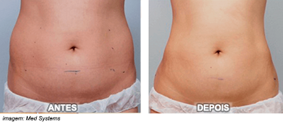 ultrassom microfocado antes e depois