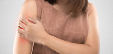 Alergia à Picada de Inseto – Revista Guia da Farmácia