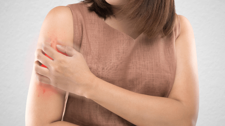 Alergia à Picada de Inseto – Revista Guia da Farmácia