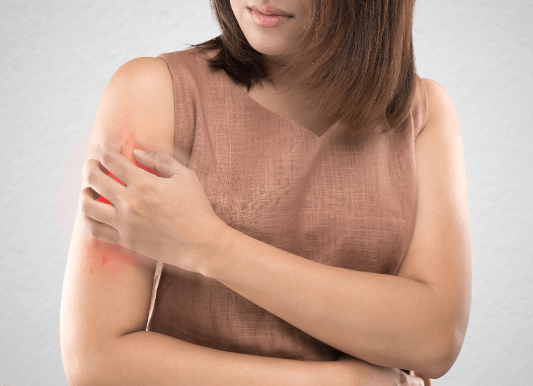 Alergia à Picada de Inseto – Revista Guia da Farmácia